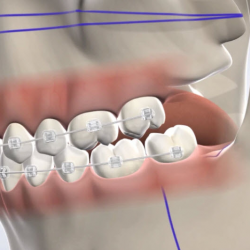  Orthognathic Surgery