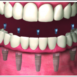 Full-Arch Restoration