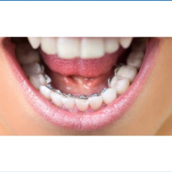 Invisible Braces (Lingual Braces)