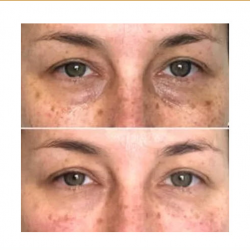 Undereye Treatment