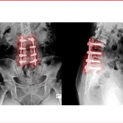 Lumbar Fusion