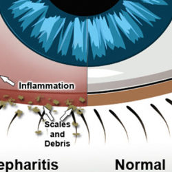 Blepharitis Treatment