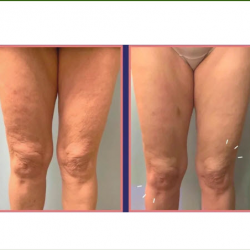  Cryo-Slimming Session 