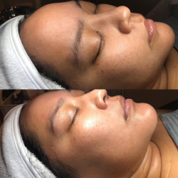 Dermaplane Facial