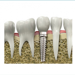  Dental Implants