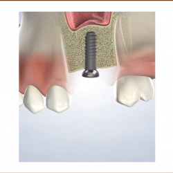 Bone Grafting