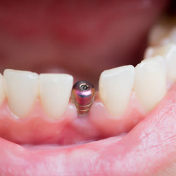Dentures