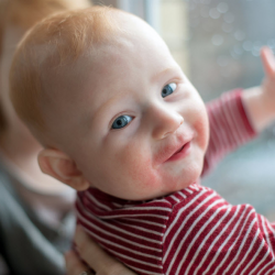 Rashes and Allergic Reactions, Allergies