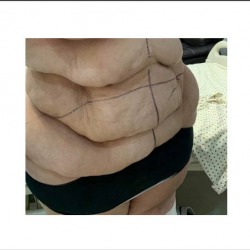 Tummy Tuck (Abdominoplasty)