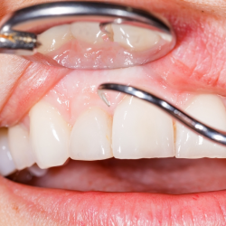 Gum Disease (Periodontal) Treatment