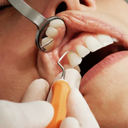 Prophylaxis (Cleaning)