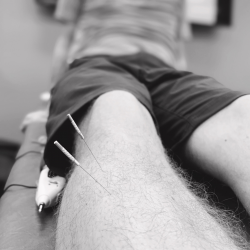 Dry Needling