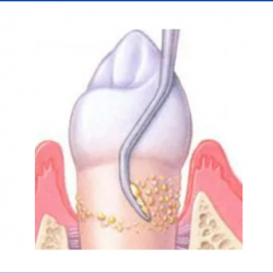 Cleanings, Scaling and Root Planing
