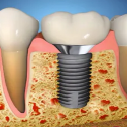 Fixed Partial Dentures (Bridges) and Dental Implant Restorations