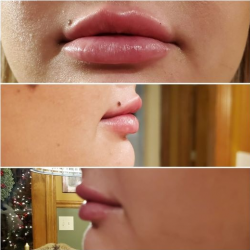 Lip Fillers
