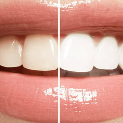 Teeth Whitening