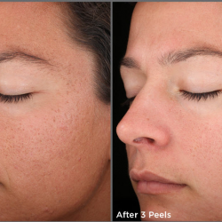 Chemical Dermal Peel