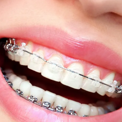 Tooth Colored Braces