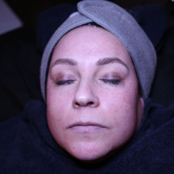 Nano Needling/Micro Needling