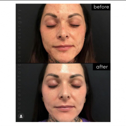 Aerolase Neo Treatment  