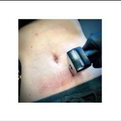 Fat Dissolving Injections