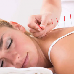 Acupuncture