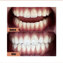 Teeth Whitening Service 
