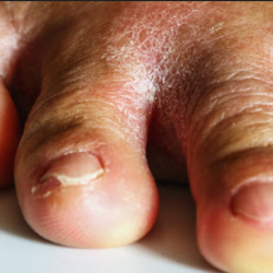 Painful Fungal Nails