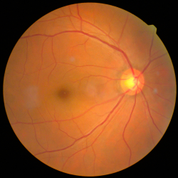 Retinal Photography