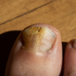 Fungal Toenails