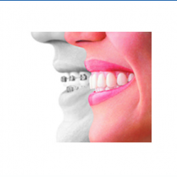 Invisalign