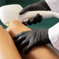 IPL Laser Hair Removal