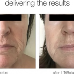 Tribella™ Facial