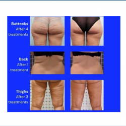 Body Contouring