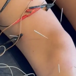 Dry Needling