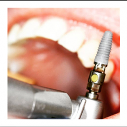 Dental Implants