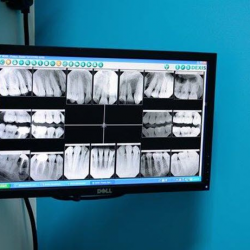 Dental X-Rays