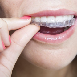 Invisalign 
