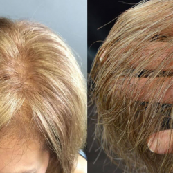 Hair Integration Systems