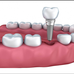  Dental Implants