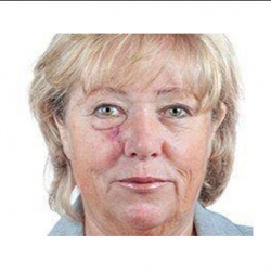 Mohs Surgery Specialist