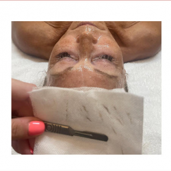 Dermaplaning