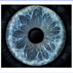 Catalys Laser Cataract Surgery