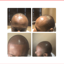 Scalp Micropigmentation