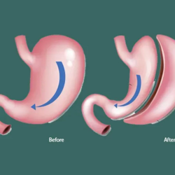 Gastric Sleeve