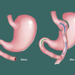 Gastric Bypass