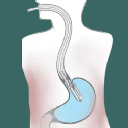 TIF Procedure