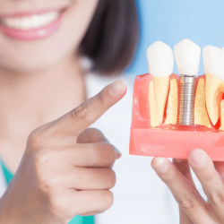 Dental Implants