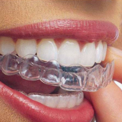 Invisalign®