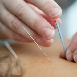 Acupuncture Therapy